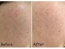 マインドール/毛穴の大掃除