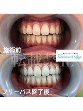 ホワイトニングサロン 福岡天神店/ホワイトニング