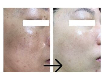 コトハ(cottha)/エルモサハーブピーリング