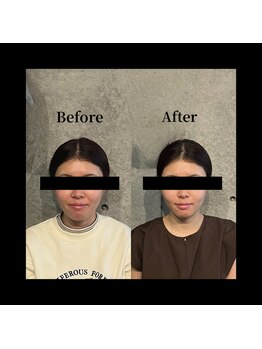 クリアランス 南青山(CLEARANCE)/美容鍼×パルス 担当SAYA