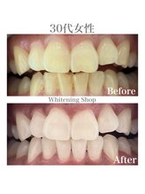 ホワイトニングショップ 広島廿日市店/before&after