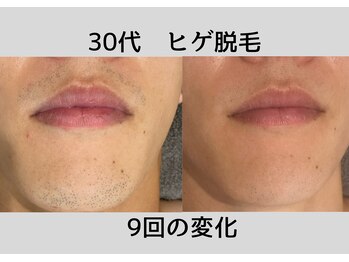 ビモア(Bmore)/★ビフォーアフター★