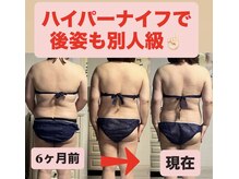 痩身ハイパーナイフメンズ【salon blue rose】新栄町/千種/痩身/ダイエット/脂肪燃焼/名古屋痩身/女性痩身/年齢問わず