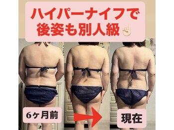 痩身ハイパーナイフメンズ【salon blue rose】新栄町/千種/痩身/ダイエット/脂肪燃焼/名古屋痩身/女性痩身/年齢問わず
