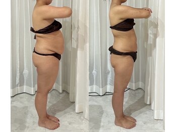 サロンドペオニー 川内店(salon de peony)の写真/サイズダウンはお任せ！国家資格保持者のカウンセリングで、「きれいに痩せる」を徹底サポート◎