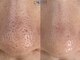 ラヴィ(Ravi)の写真/頑固な毛穴の黒ずみ改善！毛穴エクストラクション×水素毛穴洗浄×プロセルフェイシャルで驚きの艶肌美人！