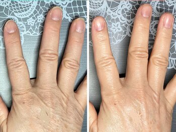 桃の木 吉祥寺店/60代　ハンドケア＆ネイルケア