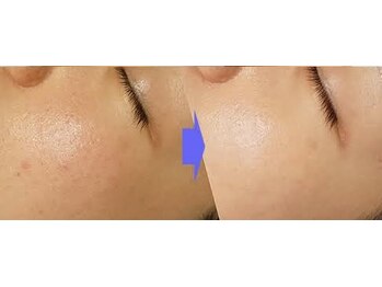 チョンダムビューティー(chondam beauty)/ハーブピーリングの効果実感1