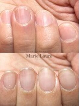 マリーロール 梅田店(Marie Laure)/自爪育成/深爪矯正/ネイルケア