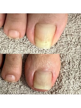 トイロ(toiro)/巻き爪補正