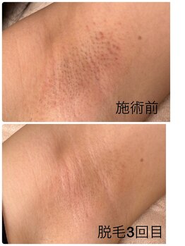 シュガー(Sugar...iyr)/ワキ脱毛5回コース