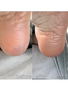 フットミー(foot mii)/