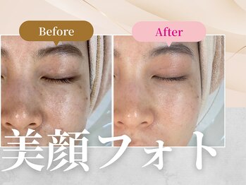 フェルナ 上新庄店(FERNA)/フェイシャル