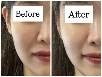 キプラ 福津店(KIPURA)/20代 小顔矯正+ナノスキン