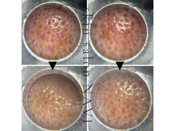 ナビ(NAVI)/毛穴詰まり/黒ずみ