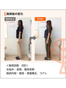 ただき接骨院 整体院 新前橋院/ お悩み：姿勢、猫背姿勢