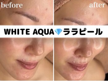 ホワイトアクア 柏店(WHITE AQUA)/ピーリング/毛穴ケア/ニキビケア