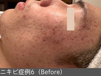 オアシスラグーン(OASIS LAGOON)/ニキビ改善(症例6 before)