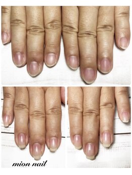 ミオンネイル(mion nail)/自爪育成
