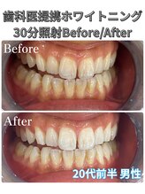 プラチナムビューティ 四条烏丸店(PLATINUM Beauty)/ホワイトニング！Before./After!