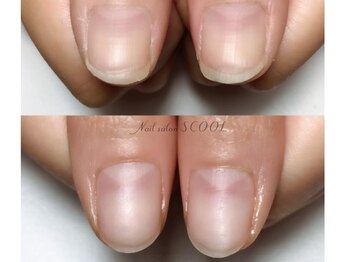 スクール(SCOOL)/ディープケア　自爪育成