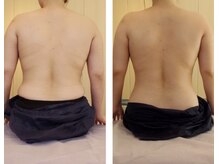 サロンハナ(Salon HANA)/一度の施術でこの背中の変化