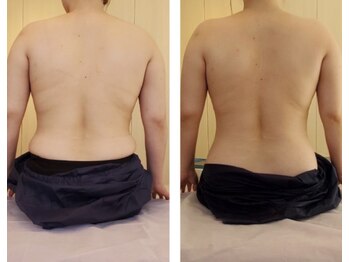 サロンハナ(Salon HANA)/一度の施術でこの背中の変化