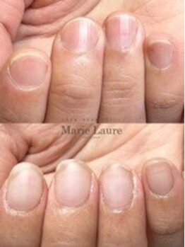 マリーロール 梅田店(Marie Laure)/自爪育成/深爪矯正/ネイルケア