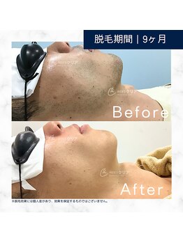 メンズクリア 天王寺店/【メンズクリア】お客様の施術例