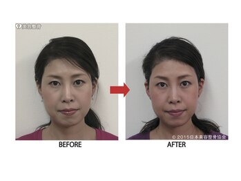 エミット(emit.)/美顔矯正　ビフォーアフター