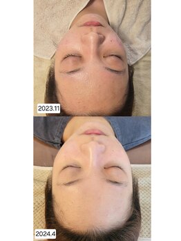 ムーフ(Moof)/施術例