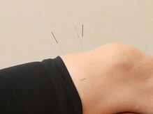 ほぐし屋百式 百式鍼灸院/鍼