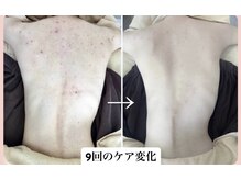 スキンハピネス(skinhappiness)/背中ハーブピーリング