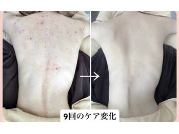 スキンハピネス(skinhappiness)/背中ハーブピーリング