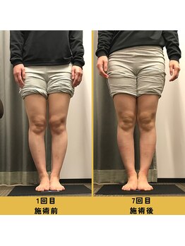 ベル/【20代会員様】O脚矯正の変化
