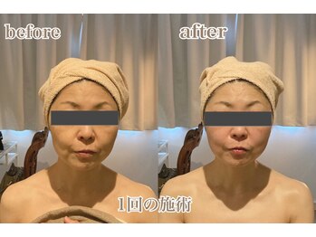 ラ フルール 折尾店/小顔矯正コルギ×頭蓋骨矯正