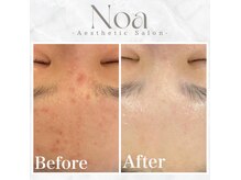 ノア 新宿(Noa)の雰囲気(ハーブピーリング/ニキビケア/毛穴/美肌/ホワイトニング/新宿)