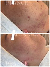 プランス 恵比寿店(PLANCE)/頑固な肌悩みも改善