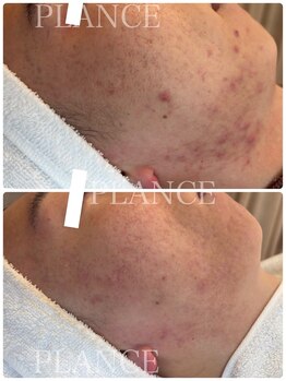 プランス 恵比寿店(PLANCE)/頑固な肌悩みも改善