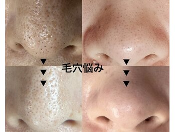 マテリアル(Material`)の写真/20代・30代、いちご鼻・黒ずみ毛穴を卒業したい人へ！ハーブピーリングでお悩み解決しませんか？