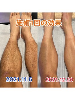 ビモア(Bmore)/★ビフォー・アフター★Vol.1