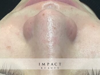 インパクト(IMPACT)の写真/《感動間違いなし！お鼻の黒ずみケア》気になる黒ずみ開きをスッキリ解決♪トーンアップやざらつき解消に◎