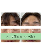 ソルニス(Solnis.)/【クマ】針を使わない脂肪撃退