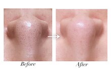 ルブラン(Lu'Bulan)/【毛穴エクストラクション】