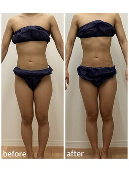 リル(Lil)/ハイパーナイフ痩身/全身