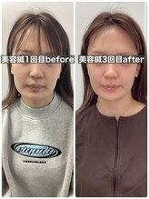 ハリサロンドオフ 堺東店(hari salon de off)/お客様before→after