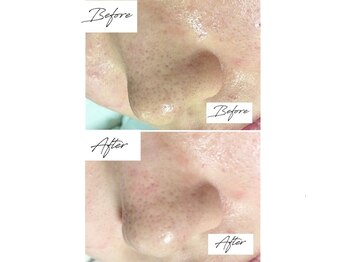 ビズビズ 梅田店(bisebise)/ニキビケア/ハイドラ毛穴洗浄