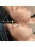 【小顔★韓国美容】レモンボトル2ミリ+EMSリフト&デコルテマッサージコース
