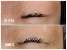 キーオブフェイス(Key of Face)/お悩み【目の下のシワ】