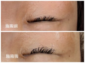 キーオブフェイス(Key of Face)/お悩み【目の下のシワ】